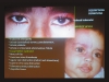 Рис. 6. Вторичная глаукома, ассоциируемая с врожденным системным заболеванием или синдромом