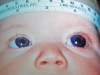 Рис. 8. Врожденная глаукома. Асимметрия размеров роговицы по сравнению с парным глазом