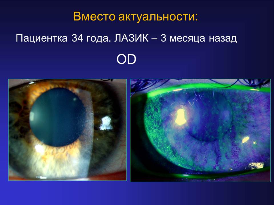 Значение синдрома «сухого глаза» при планировании эксимерлазерной коррекции  - Издательство АПРЕЛЬ