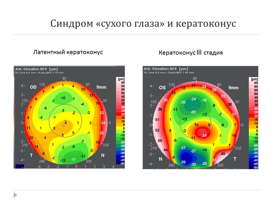 Задняя элевация роговицы что это. Смотреть фото Задняя элевация роговицы что это. Смотреть картинку Задняя элевация роговицы что это. Картинка про Задняя элевация роговицы что это. Фото Задняя элевация роговицы что это Задняя элевация роговицы что это. Смотреть фото Задняя элевация роговицы что это. Смотреть картинку Задняя элевация роговицы что это. Картинка про Задняя элевация роговицы что это. Фото Задняя элевация роговицы что это