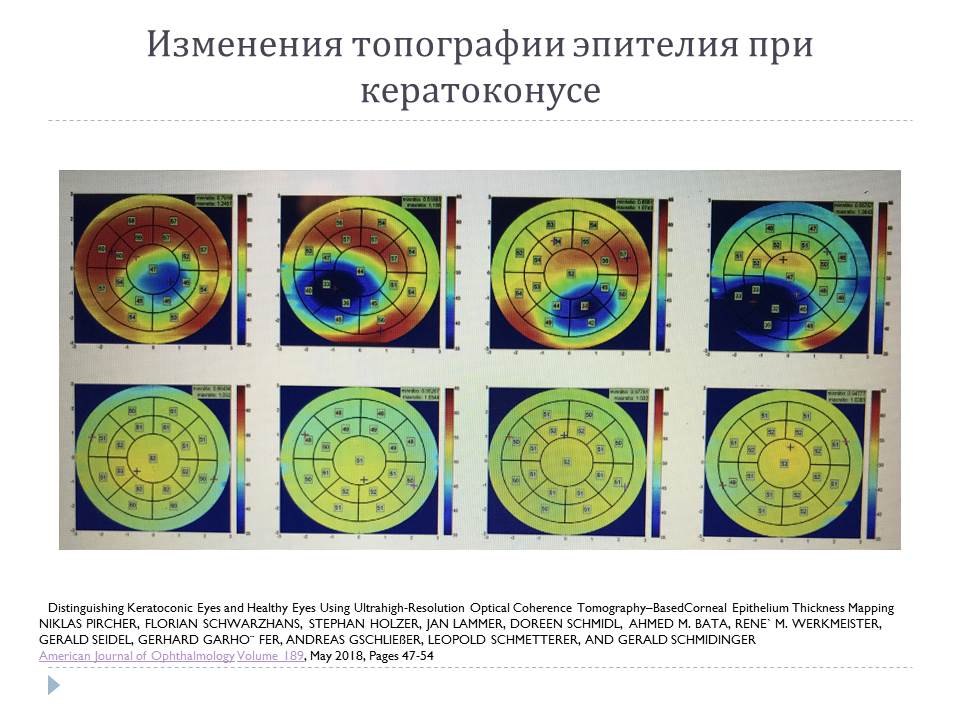 Задняя элевация роговицы что это. Смотреть фото Задняя элевация роговицы что это. Смотреть картинку Задняя элевация роговицы что это. Картинка про Задняя элевация роговицы что это. Фото Задняя элевация роговицы что это Задняя элевация роговицы что это. Смотреть фото Задняя элевация роговицы что это. Смотреть картинку Задняя элевация роговицы что это. Картинка про Задняя элевация роговицы что это. Фото Задняя элевация роговицы что это