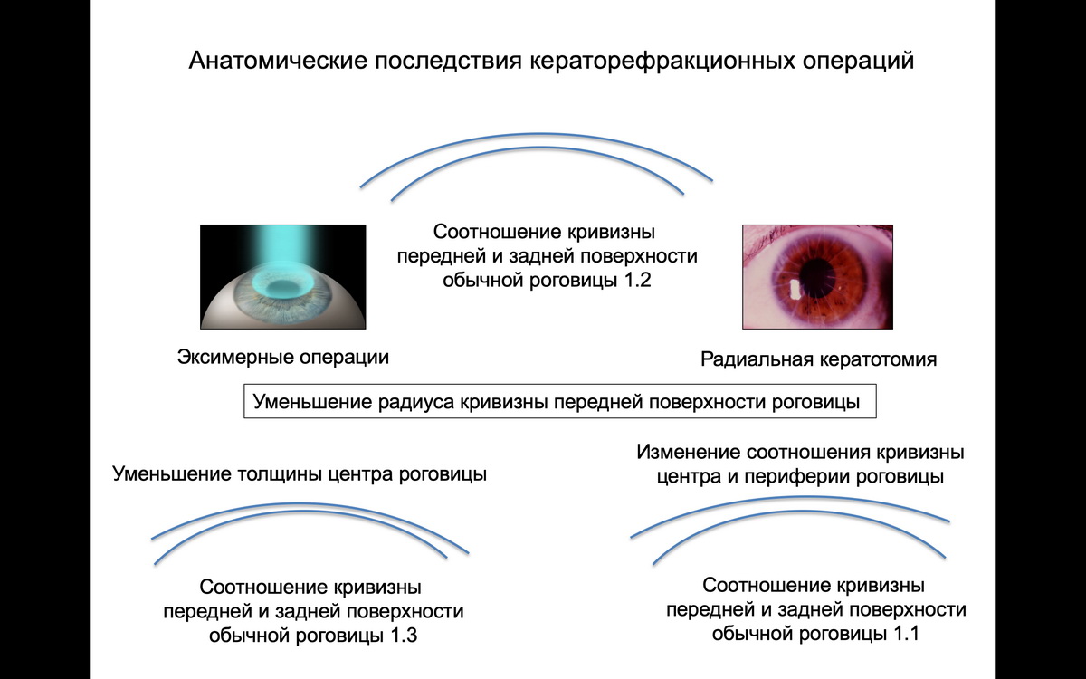 Особенности факоэмульсификации и расчета интраокулярных линз у пациентов  после кераторефракционных операций. - Страница 5 из 7 - Издательство АПРЕЛЬ