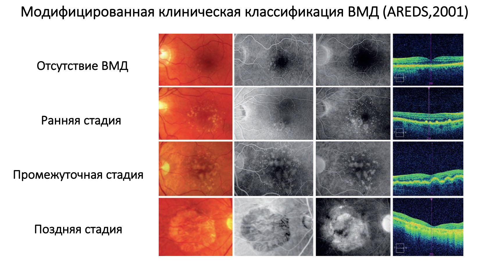 Возрастная макулярная дегенерация презентация