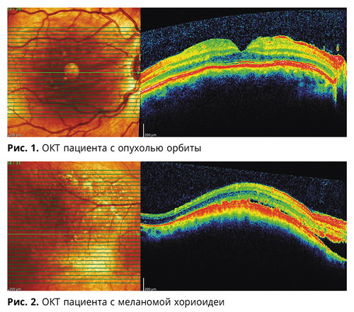Морфометрическая картина сетчатки при опухолях орбиты и меланомах хориоидеи