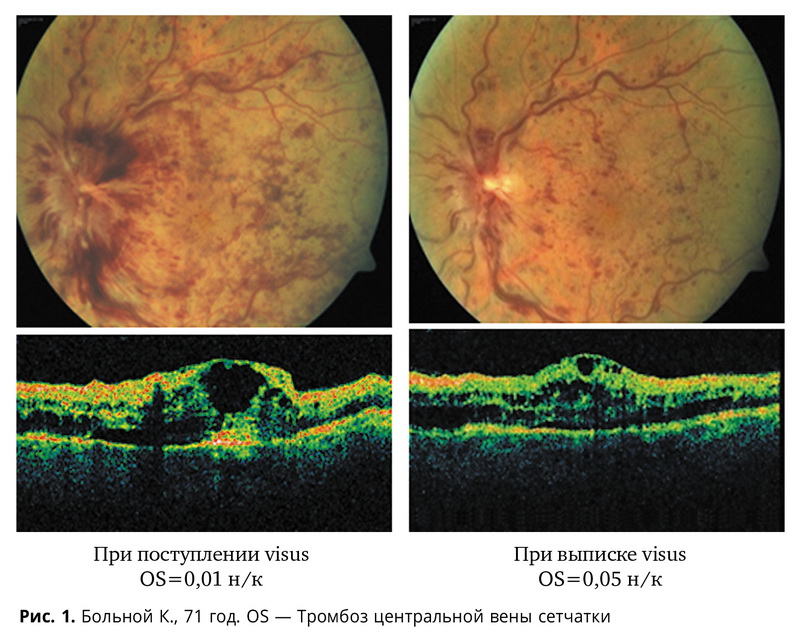 Результаты лечения острой патологии вен сетчатки и посттромботической ретинопатии