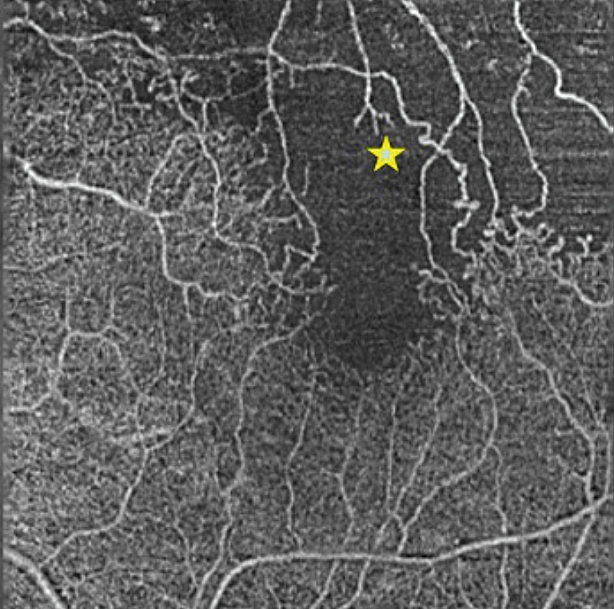 Рис. 2. ОКТ-ангиограмма пациента с окклюзией ветви вены сетчатки: визуализируется неперфузируемая область, распространяющаяся на границу аваскулярной зоны фовеа