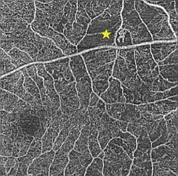 Рис. 3. ОКТ-ангиограмма пациента с диабетической ретинопатией. Визуализируется неперфузируемая область сетчатки и интраретинальные микроваскулярные аномалии (IRMA); центральная зона макулы — без признаков патологии 