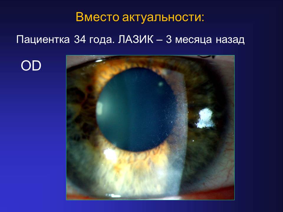 Значение синдрома «сухого глаза» при планировании эксимерлазерной коррекции