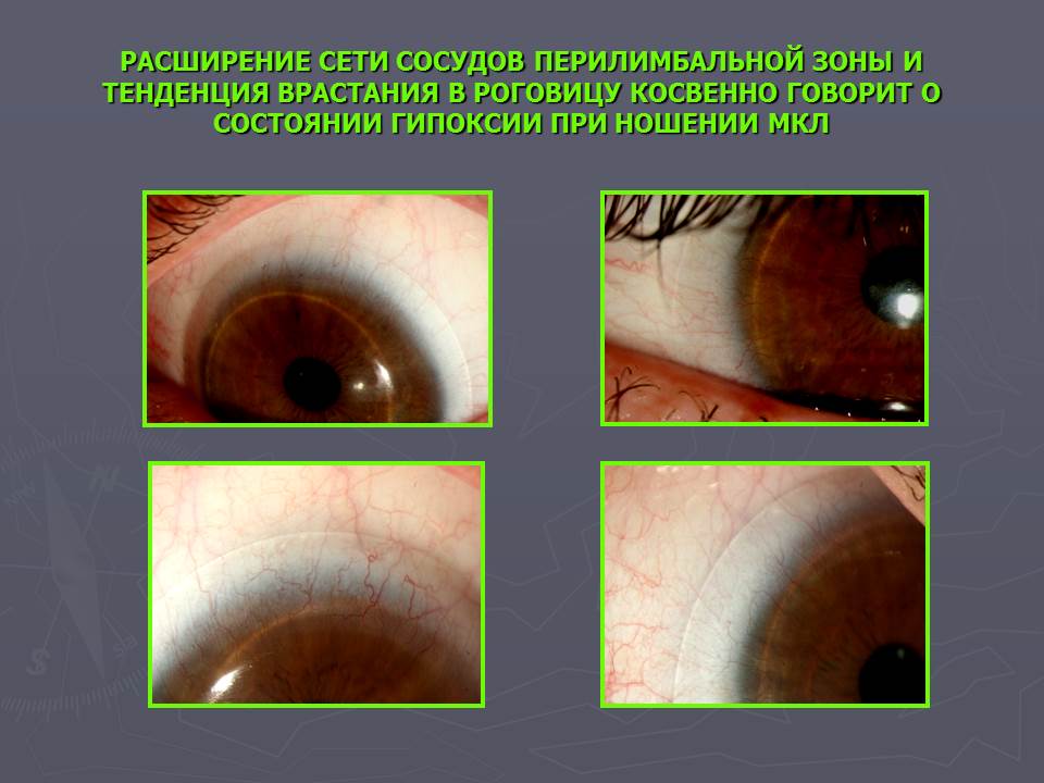 Влияние различных типов контактных линз на состояние глазной поверхности