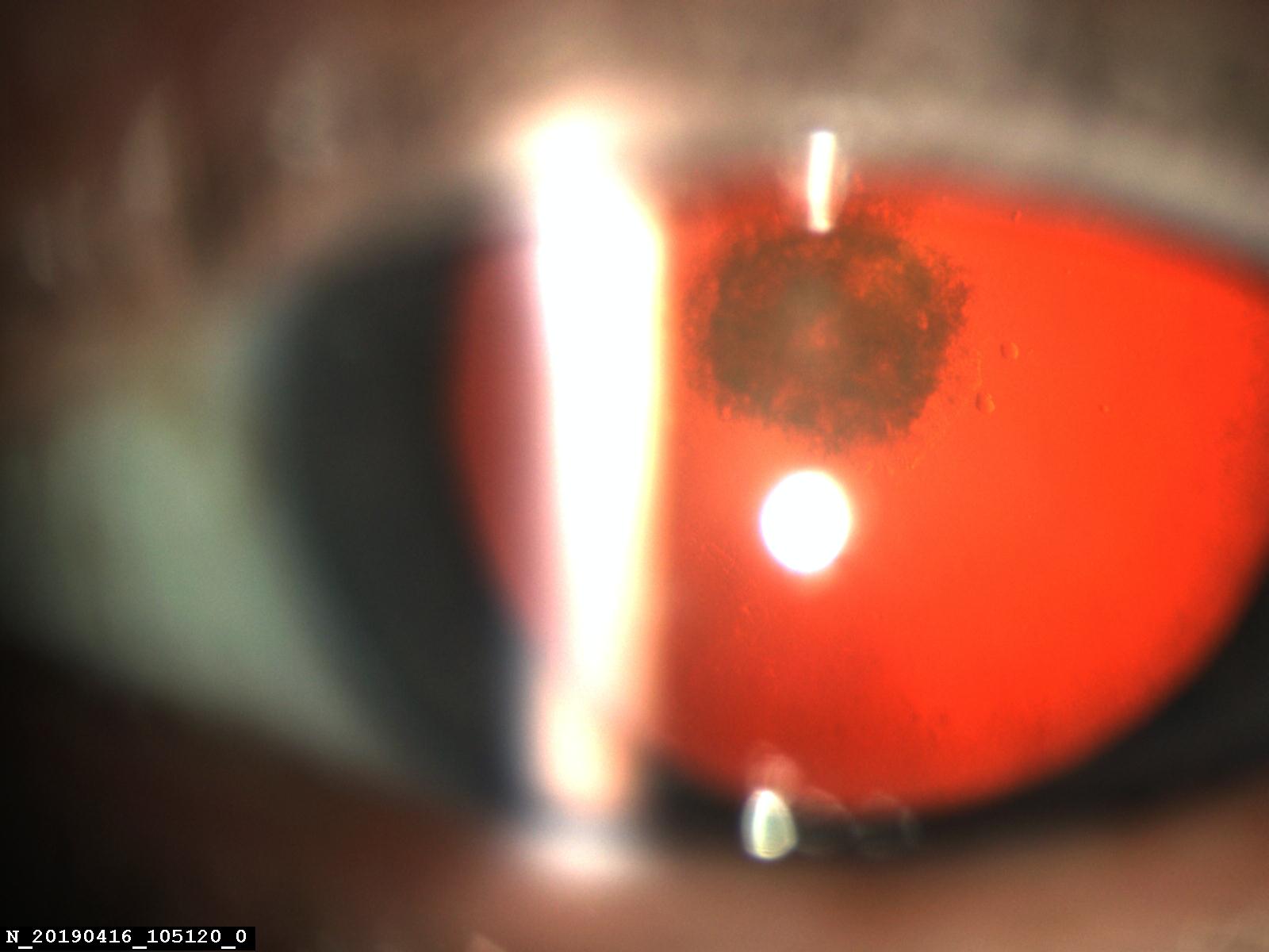 Факоэмульсификации заднеполярной катаракты