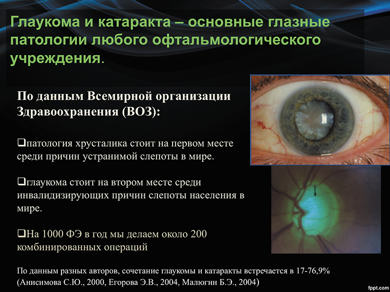 Комбинированная хирургия глаукомы и катаракты с фемтолазерным сопровождением