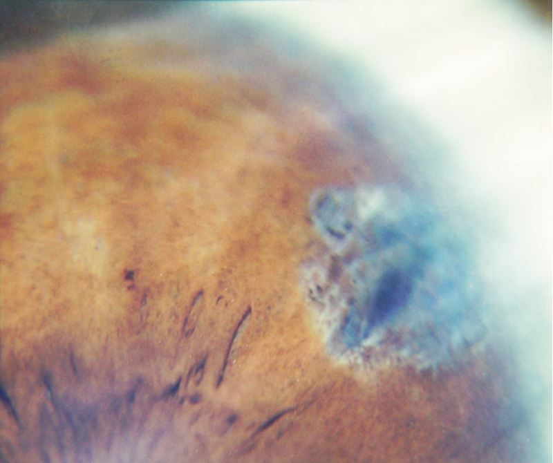 Лазерное лечение глауком